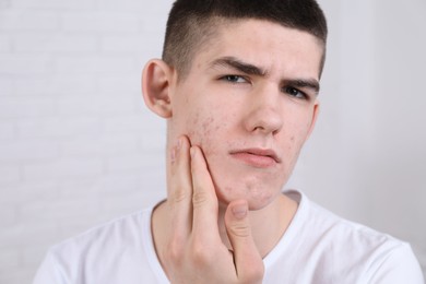Photo of Young man touching pimple on his face indoors. Acne problem