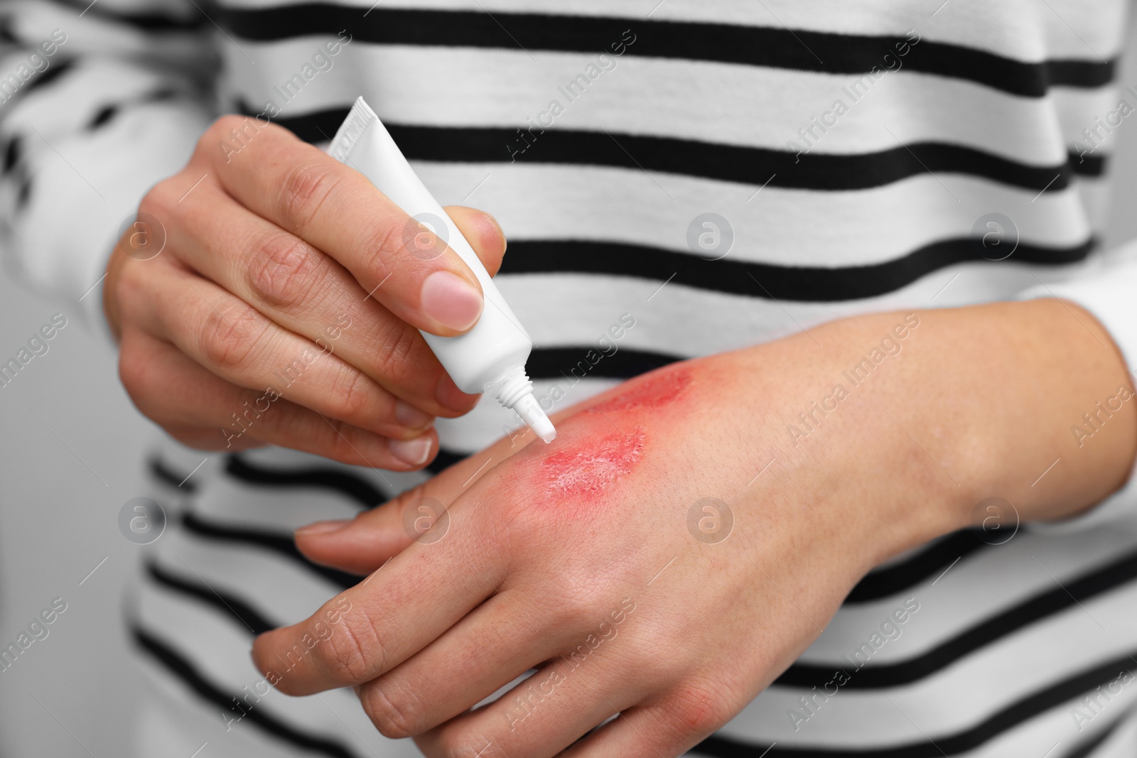 Photo of Woman applying healing cream onto burned hand, closeup