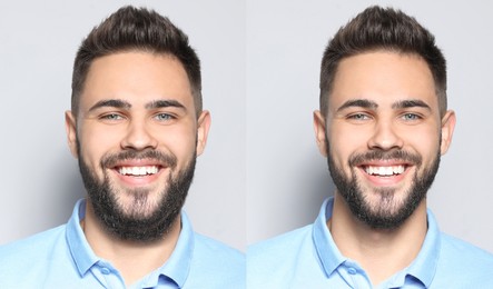 Image of Double chin problem. Collage with photos of man before and after plastic surgery procedure on light grey background
