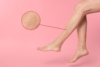 Image of Woman suffering from varicose veins on pink background, closeup. Magnified skin surface showing affected area