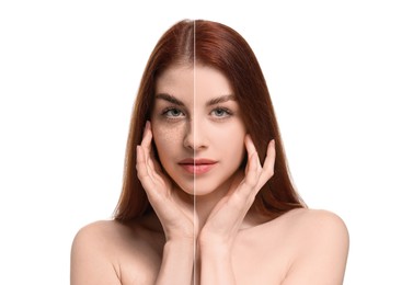 Woman with freckles and clear skin on white background, collage