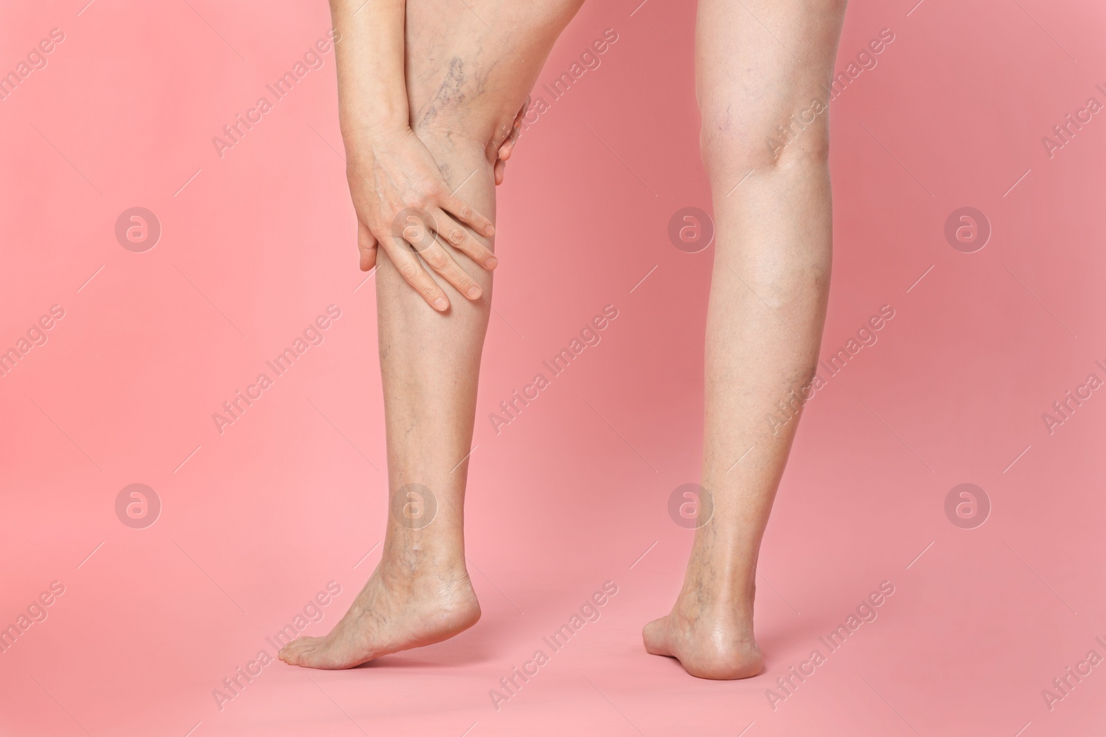 Photo of Closeup view of woman suffering from varicose veins on pink background