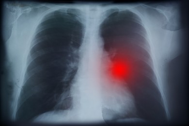 X-ray image of patient with lung cancer. Illustration