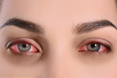 Image of Woman with red eyes suffering from conjunctivitis, closeup