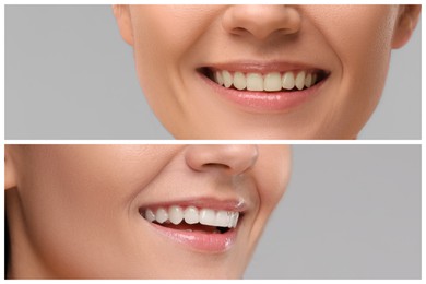 Image of Woman showing teeth before and after whitening on grey background, collage