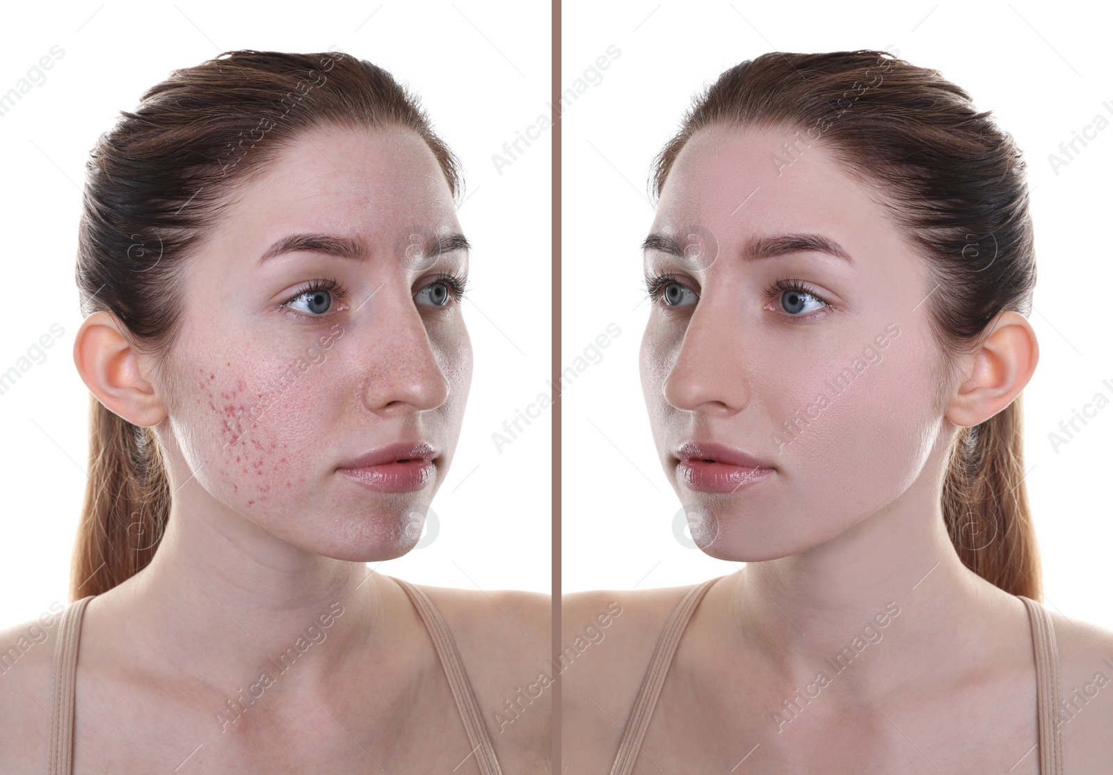 Image of Acne problem. Young woman before and after treatment on white background, collage of photos