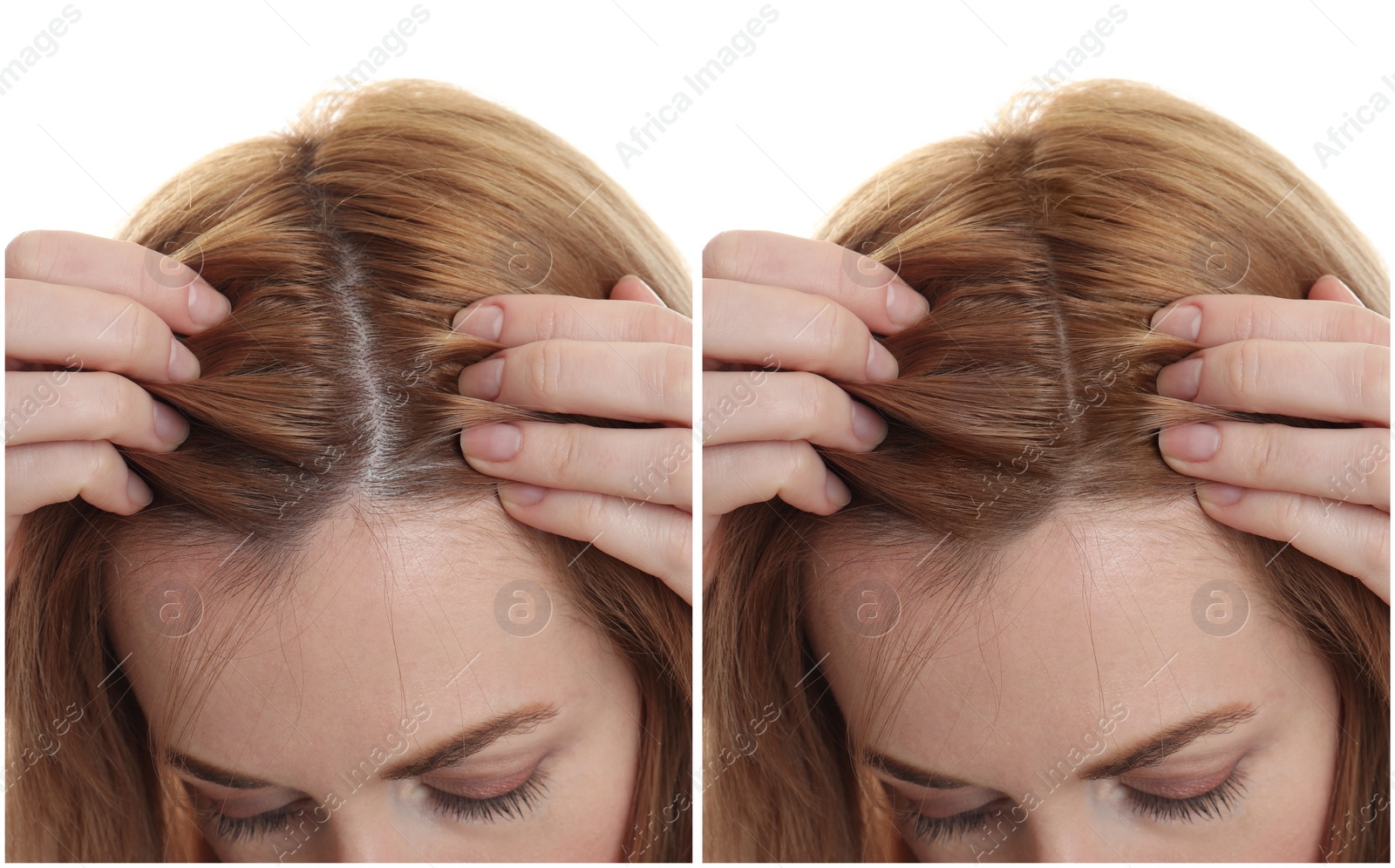 Image of Woman suffering from baldness on white background, closeup. Collage with photos before and after treatment