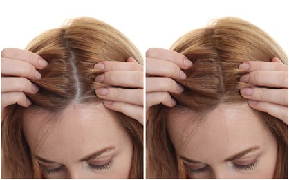 Woman suffering from baldness on white background, closeup. Collage with photos before and after treatment
