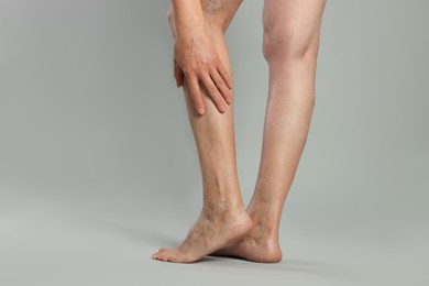 Closeup view of woman with varicose veins on light grey background