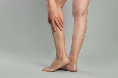 Photo of Closeup view of woman with varicose veins on light grey background