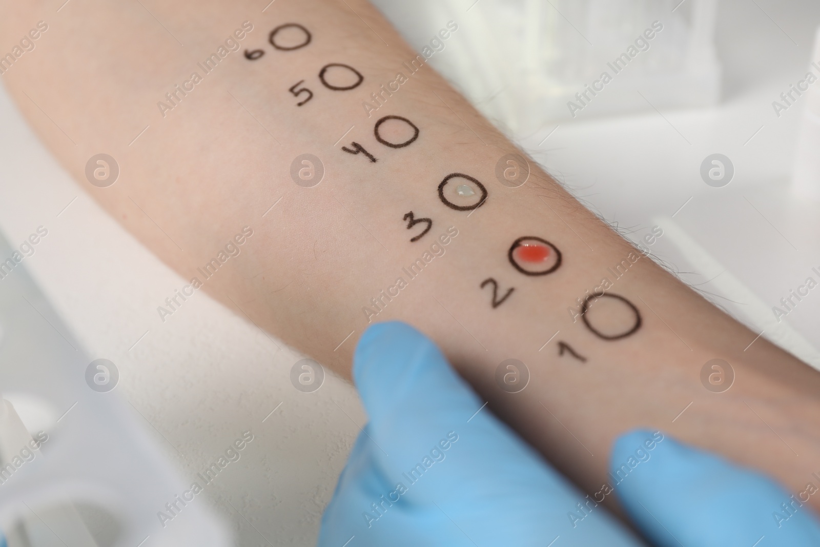 Photo of Patient undergoing skin allergy test at light table in clinic, closeup