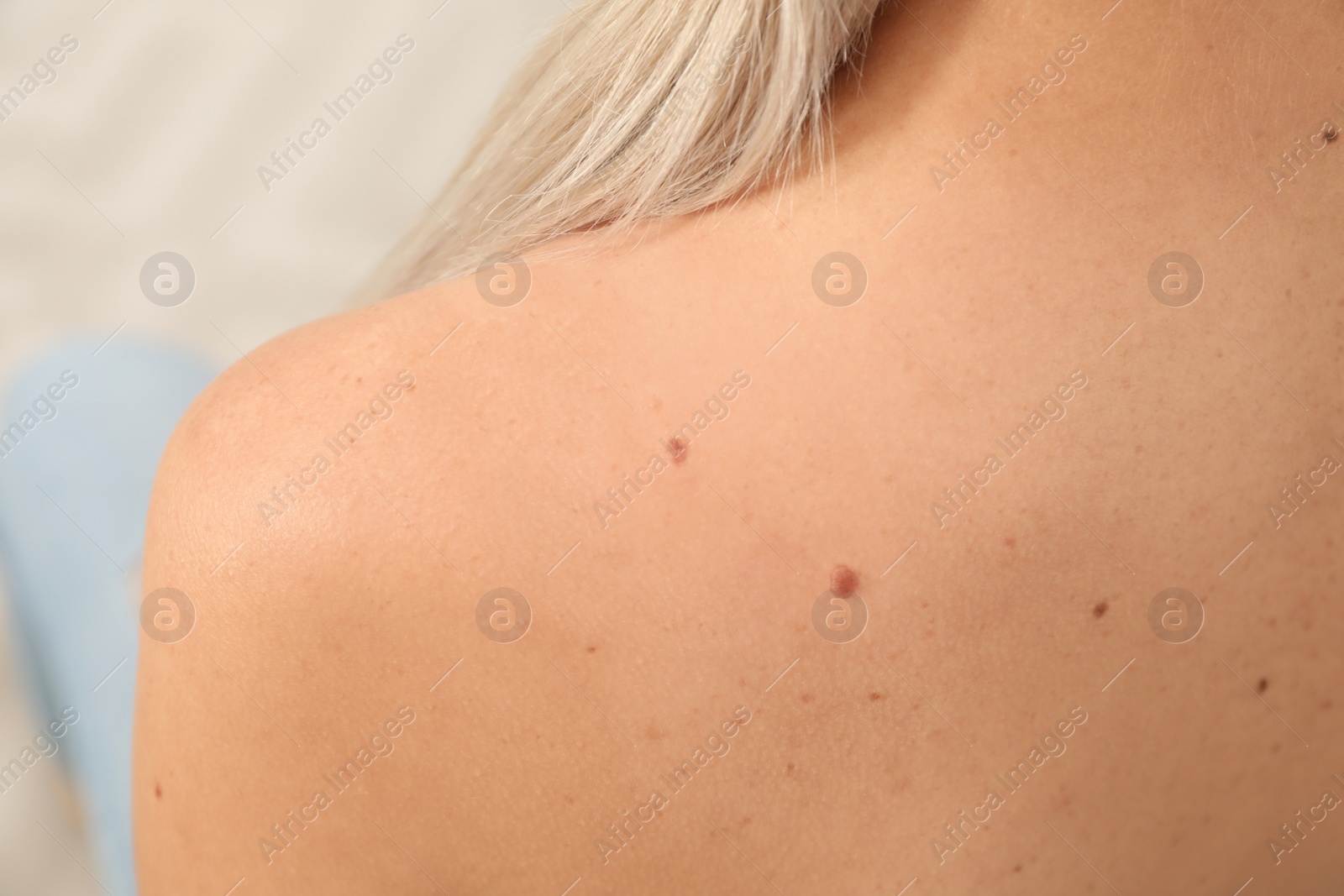 Photo of Closeup of woman`s body with birthmarks, back view