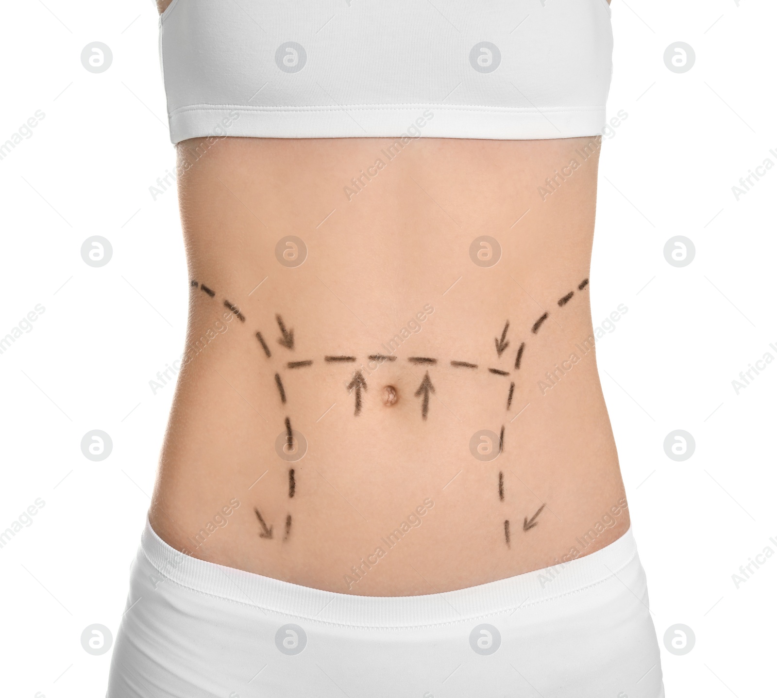 Photo of Young woman with marks on belly for cosmetic surgery operation against white background