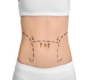 Young woman with marks on belly for cosmetic surgery operation against white background