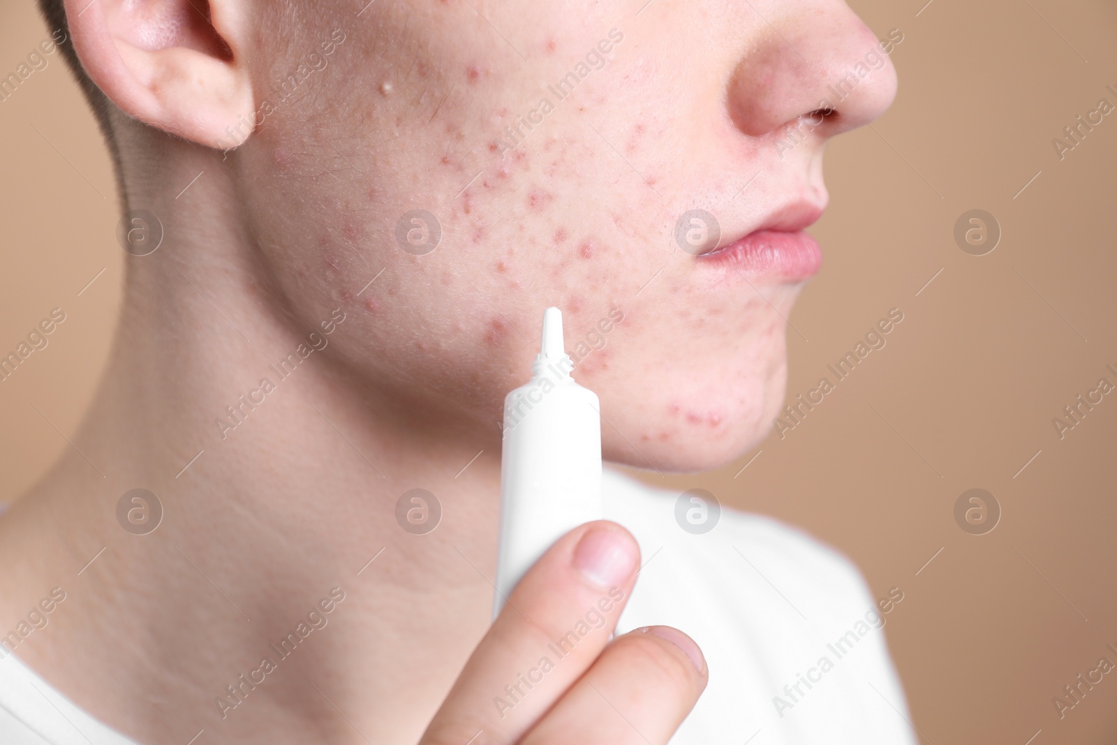 Photo of Young man with acne problem applying cosmetic product onto his skin on beige background, closeup