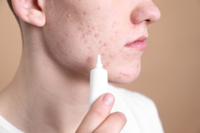 Photo of Young man with acne problem applying cosmetic product onto his skin on beige background, closeup