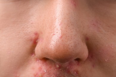 Young man with acne problem, closeup view of nose