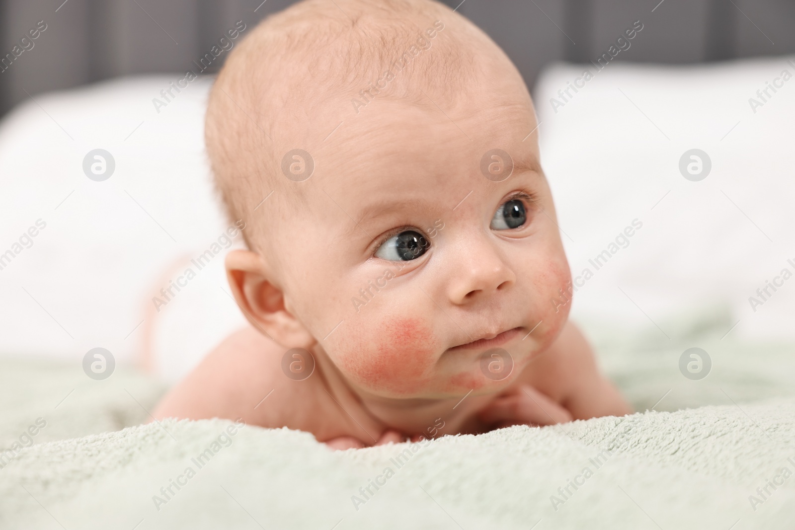 Photo of Cute little baby with allergic redness on cheeks lying on bed at home