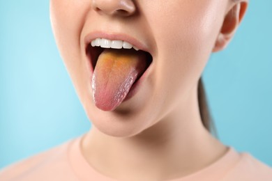 Gastrointestinal diseases. Woman showing her yellow tongue on light blue background, closeup
