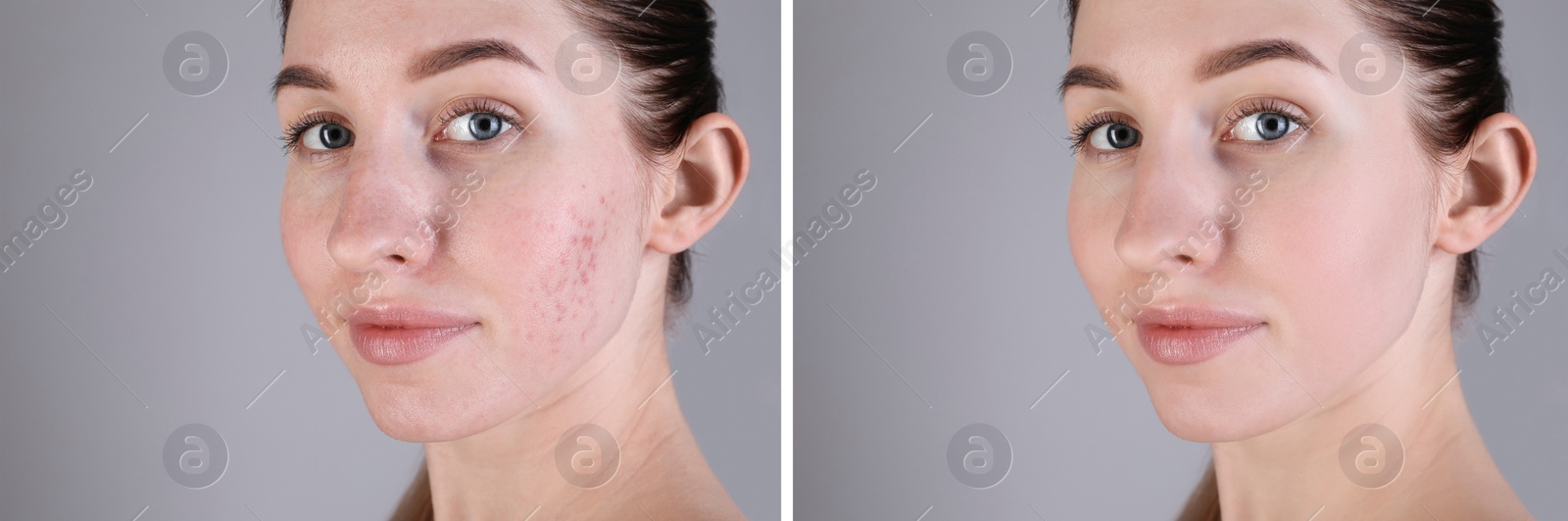 Image of Acne problem. Young woman before and after treatment on grey background, collage of photos