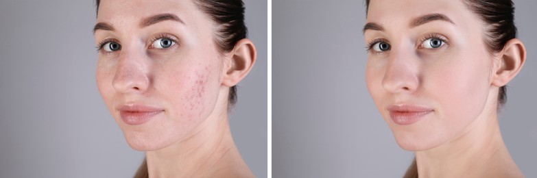 Image of Acne problem. Young woman before and after treatment on grey background, collage of photos