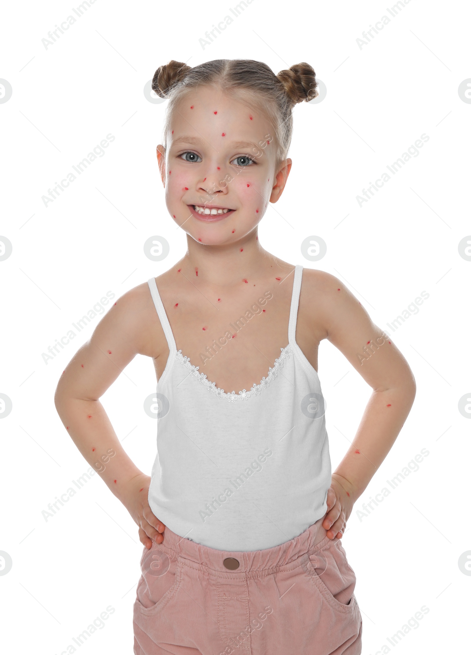 Photo of Little girl with chickenpox on white background. Varicella zoster virus