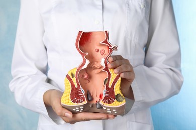 Photo of Doctor holding model of unhealthy lower rectum on light blue background, closeup. Hemorrhoid problem