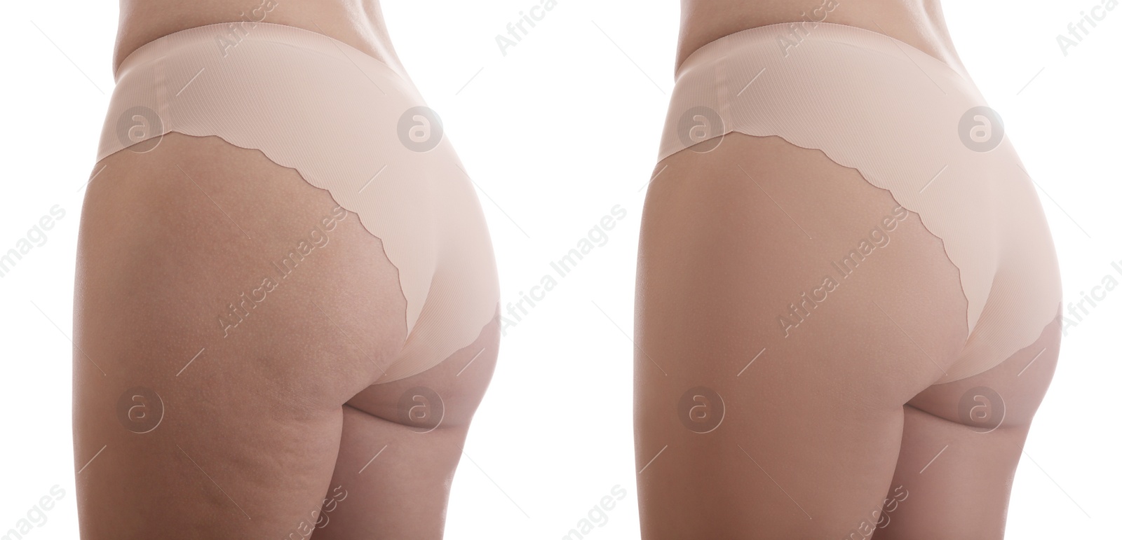 Image of Collage with photos of woman before and after anti cellulite treatment on white background, 