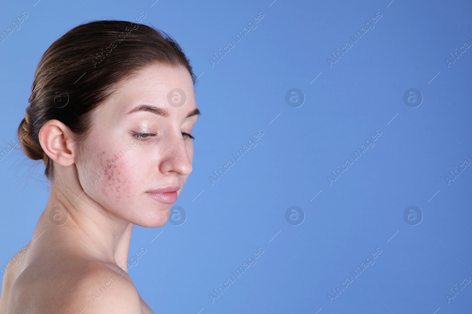 Photo of Young woman with acne problem on blue background. Space for text