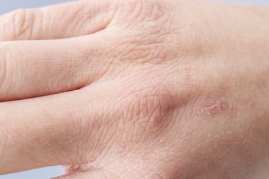 Photo of Woman with dry skin on hand, closeup