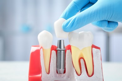 Dentist putting crown onto abutment of dental implant between teeth on blurred background, closeup