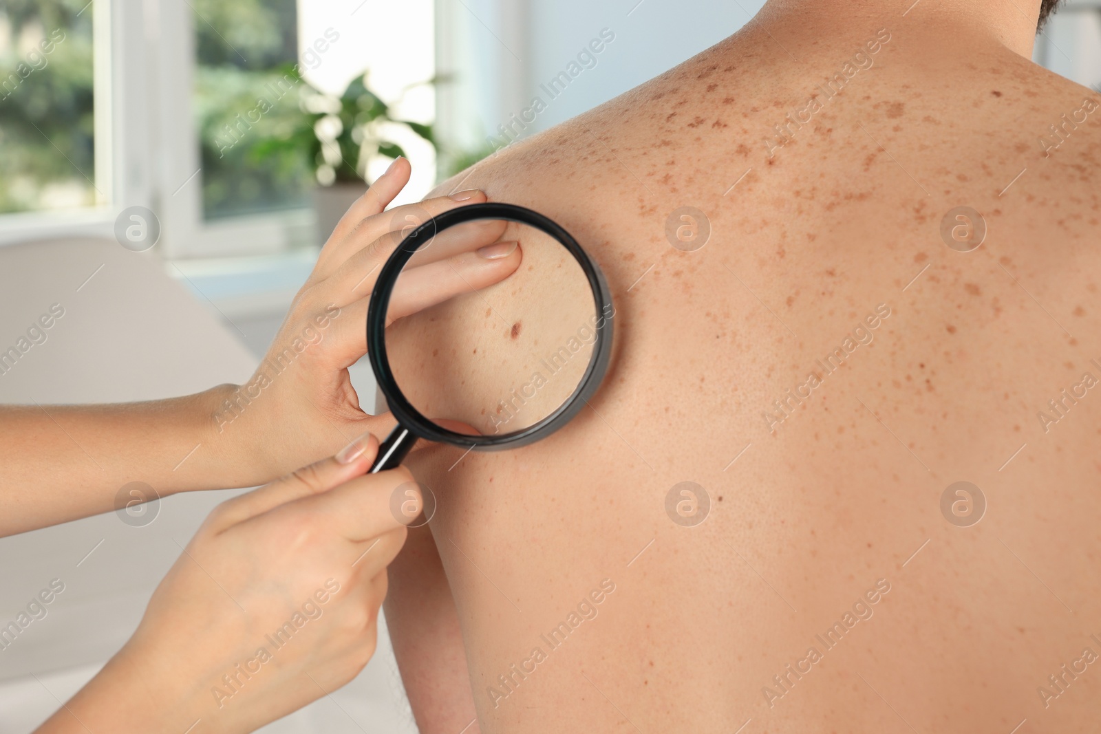 Photo of Dermatologist examining patient's birthmark with magnifying glass in clinic, closeup