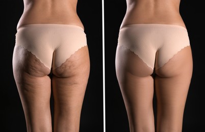 Image of Collage with photos of woman before and after anti cellulite treatment on black background, 