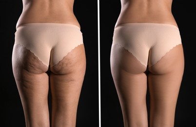 Collage with photos of woman before and after anti cellulite treatment on black background, 