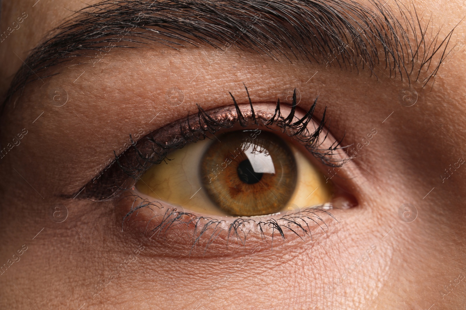 Photo of Woman with yellow eyes as background, closeup. Liver problems symptom