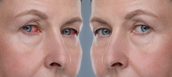 Image of Before and after conjunctivitis treatment. Photos of woman with red and healthy eyes, collage