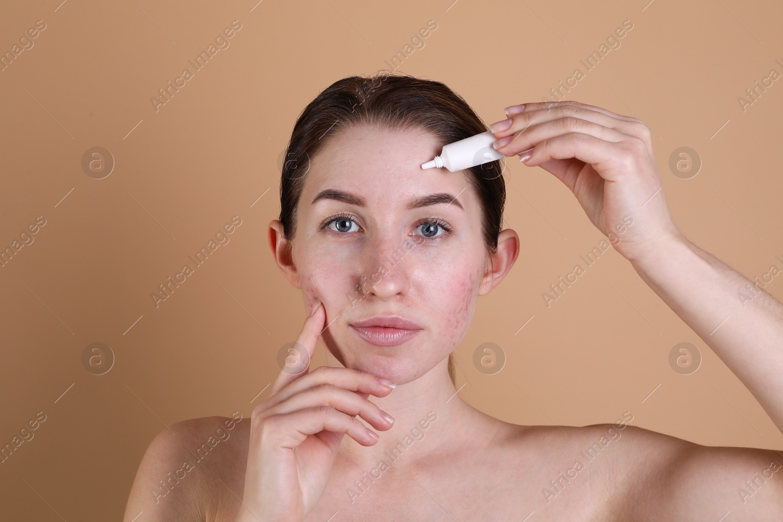 Photo of Young woman with acne problem applying cosmetic product onto her skin on beige background