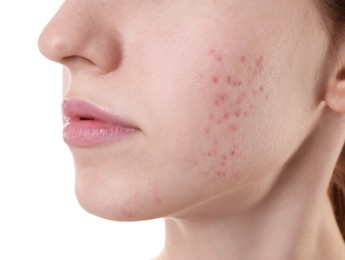 Young woman with acne problem on white background, closeup