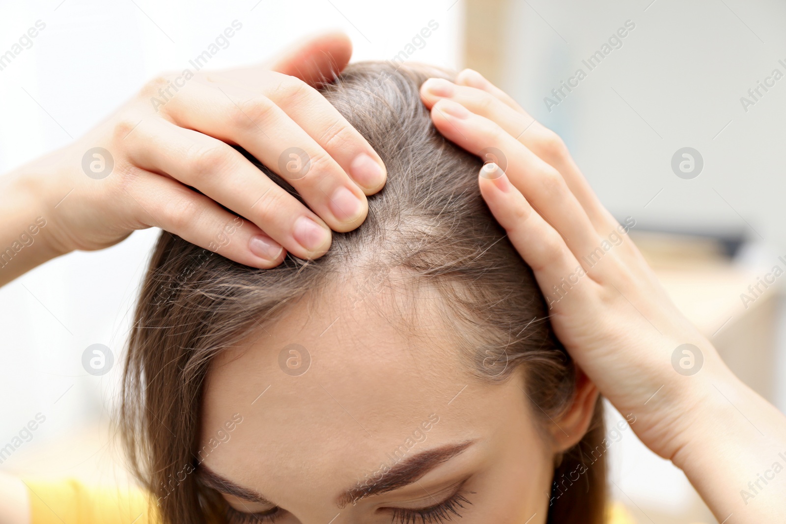 Photo of Young woman with hair loss problem indoors, closeup