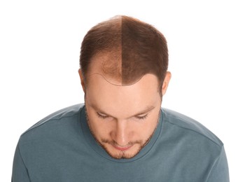 Image of Man with hair loss problem before and after treatment on white background, collage. Visiting trichologist