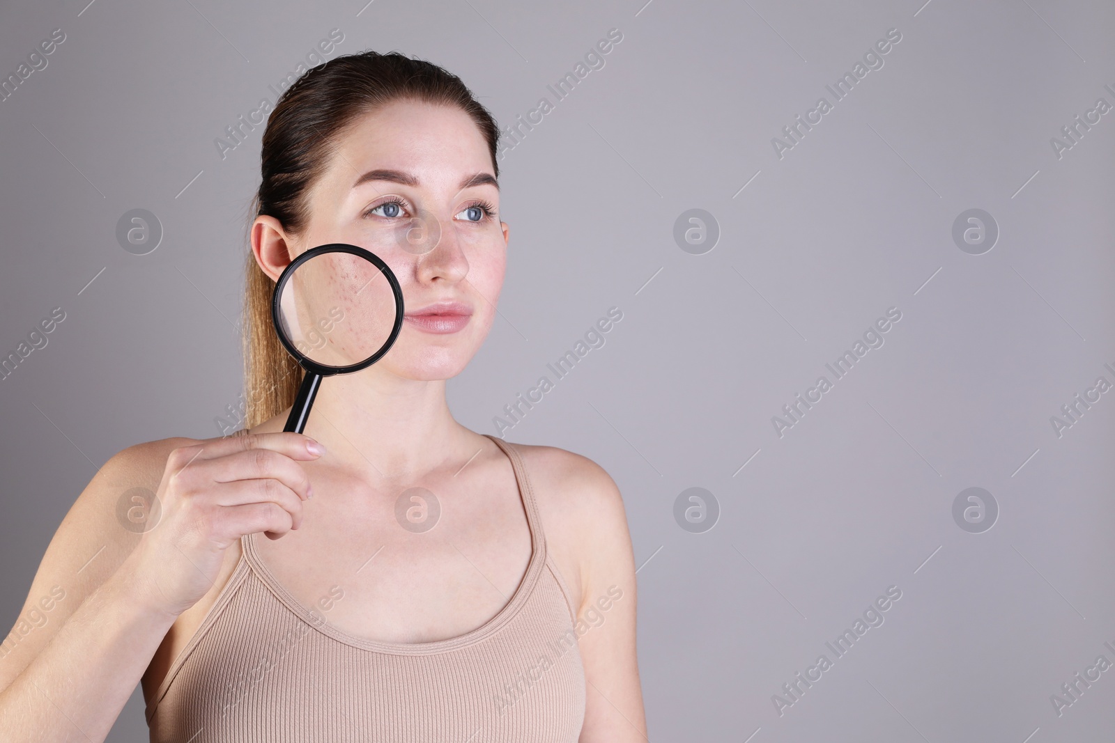 Photo of Young woman with acne problem holding magnifying glass near her skin on light grey background. Space for text
