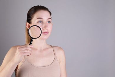 Young woman with acne problem holding magnifying glass near her skin on light grey background. Space for text