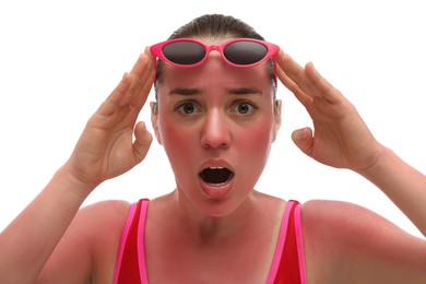 Photo of Woman with sunburned skin on white background