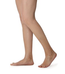 Photo of Closeup view of woman with varicose veins on white background