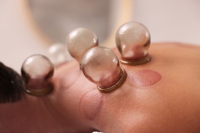 Cupping therapy. Closeup view of man with glass cups on his back indoors