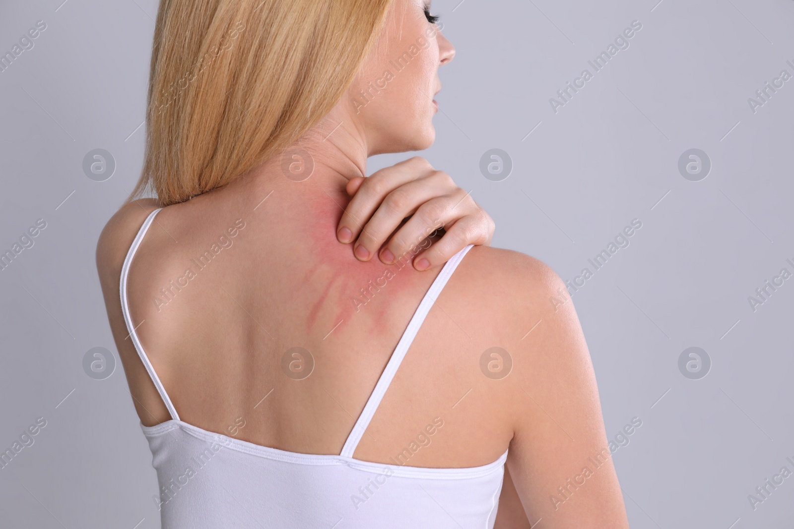 Photo of Woman with allergy symptoms scratching shoulder on grey background, closeup