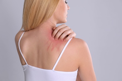 Woman with allergy symptoms scratching shoulder on grey background, closeup