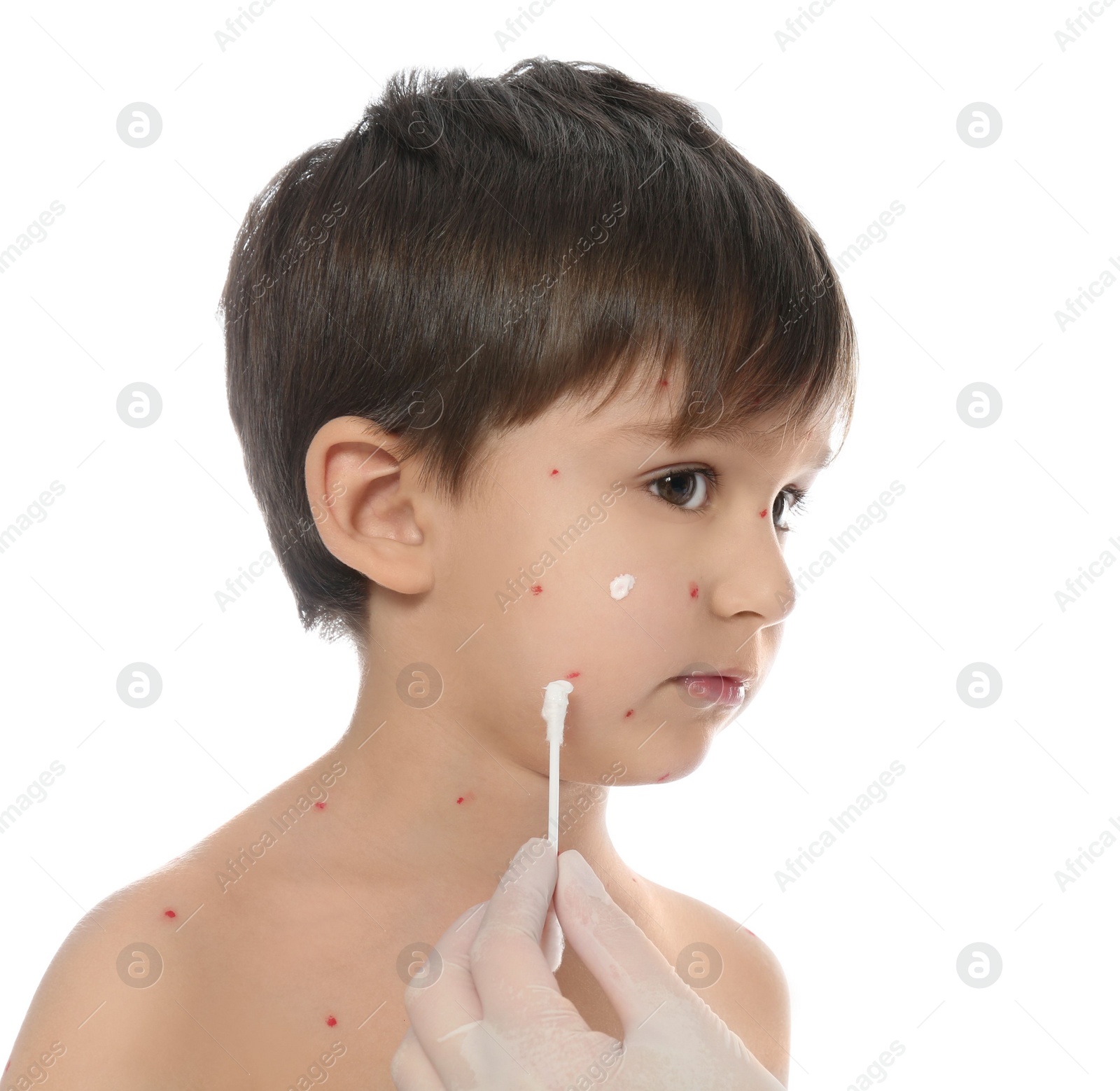 Photo of Doctor applying cream onto skin of little boy with chickenpox against white background. Varicella zoster virus