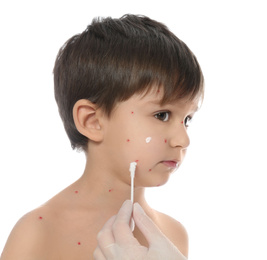 Photo of Doctor applying cream onto skin of little boy with chickenpox against white background. Varicella zoster virus