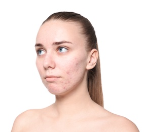 Photo of Young woman with acne problem on white background